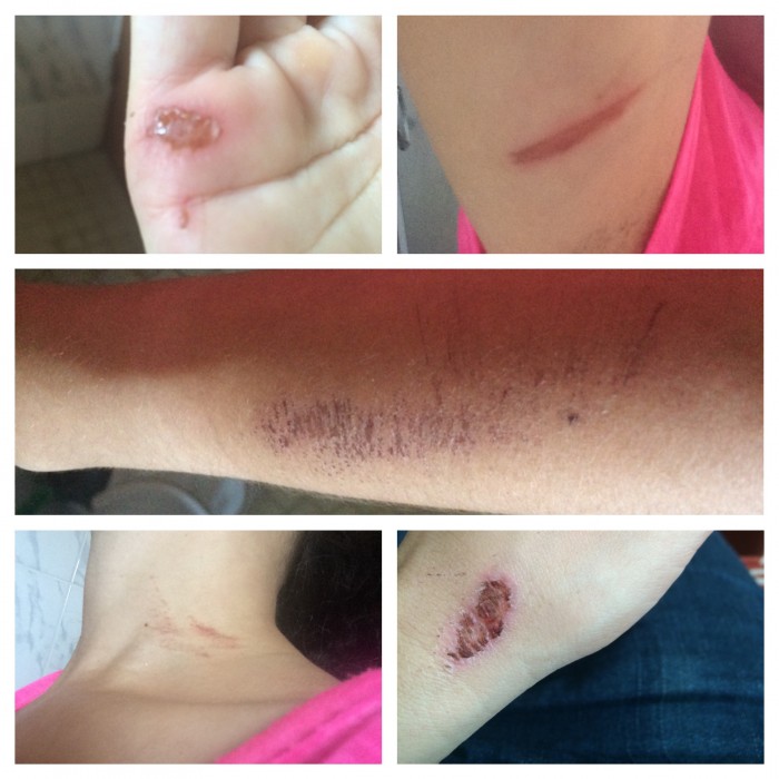 All the cuts from the assault.  Please note the image on the bottom left which shows the marks from my purse being pulled to the ground.
