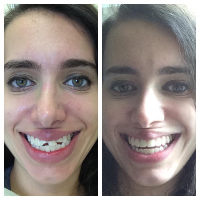 Left: This is me with broken teeth a week after I came back to the US. | Right: This is me with repaired teeth.
